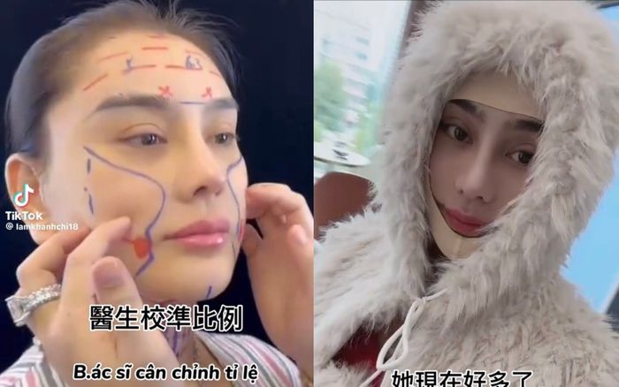 Lâm Khánh Chi ngậm ngùi 'đau lắm mọi người ơi' sau khi căng da mặt