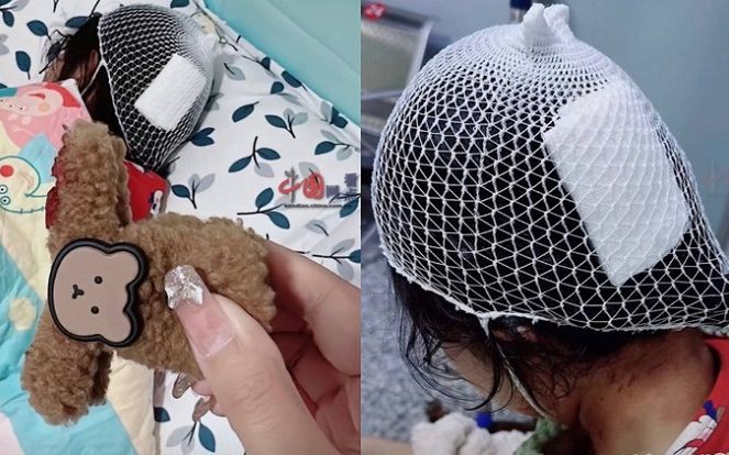 Dùng kẹp tóc càng cua, bé gái trả giá đắt không ngờ