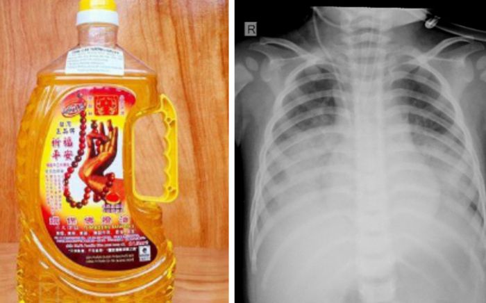 Bé 15 tháng tuổi nguy kịch nhập viện khẩn vì uống nhầm thứ thường thấy ở nhiều gia đình