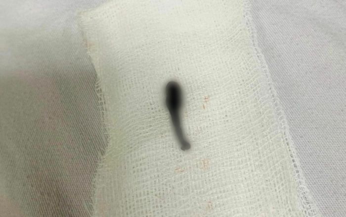 Sau khi uống nước suối vài ngày, người đàn ông nhập viện khẩn với thứ ngoe nguẩy trong mũi