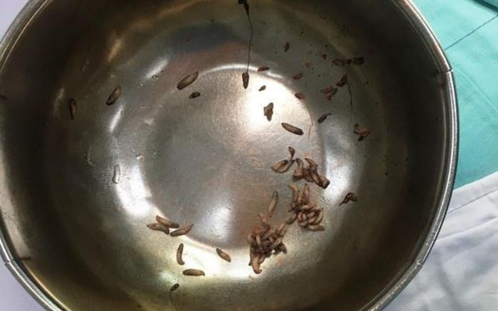 Người đàn ông được phát hiện hàng chục con ký sinh ngoe nguẩy trong khí quản