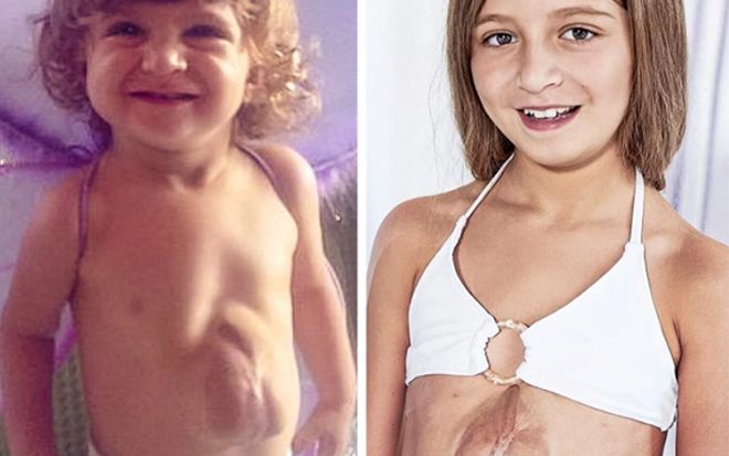 14 năm diệu kỳ của thiếu nữ sống với trái tim đập ngoài lồng ngực