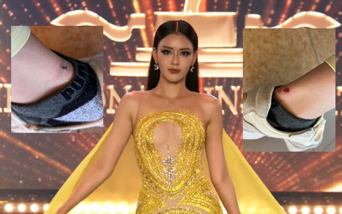 Đại diện Việt Nam tại Miss Supranational gặp sự cố, xót xa cho đôi chân sưng vù!
