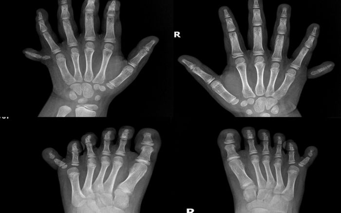 Bé gái có 12 ngón tay, 12 ngón chân cực hiếm gặp được phẫu thuật thành công