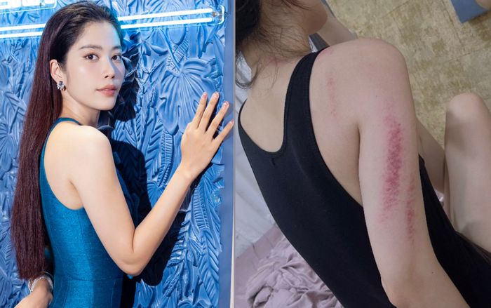 Nam Em lộ rõ thân hình gầy gò, nhiều vết bầm tím trên cơ thể khiến fan lo lắng