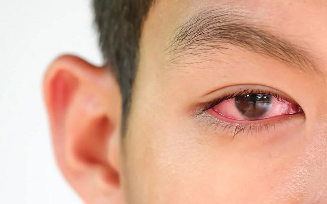 Dịch đau mắt đỏ hoành hành, làm những điều này mau khỏi, tránh biến chứng