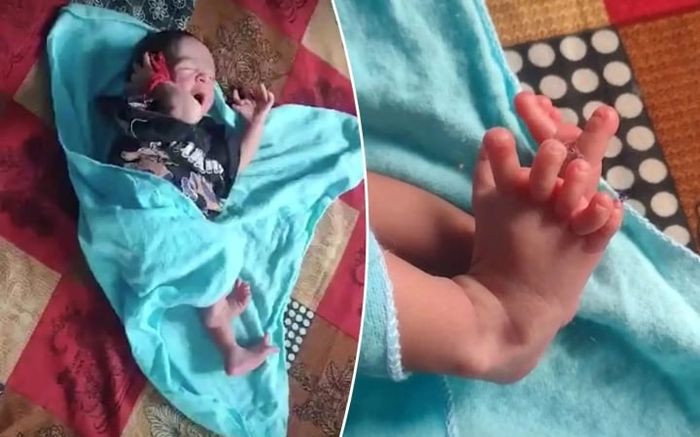 Em bé sinh ra với 26 ngón tay chân, bố mẹ mừng ra mặt vì một điều