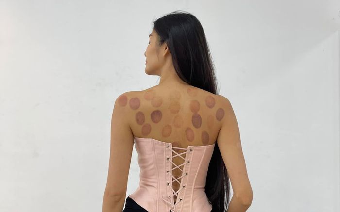 Hoàng Thùy lộ rõ sức khoẻ đáng lo, lưng chẳng chịt vết bầm đỏ