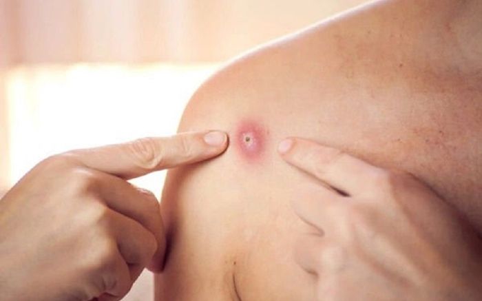 TP.HCM phát hiện 8 người tiếp xúc gần với ca mắc đậu mùa khỉ