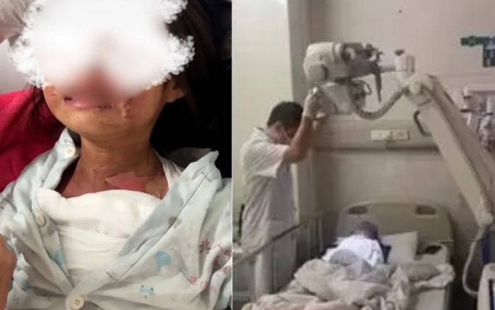 Bé gái 6 tuổi bỏng nặng vì bạn tạt nước sôi, trường học nói chỉ là trò đùa và cái kết