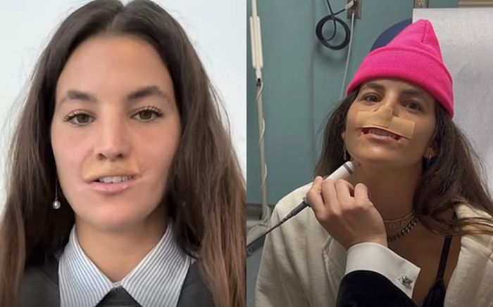 Nữ người mẫu bị mất môi trên khi bị chó dữ tấn công