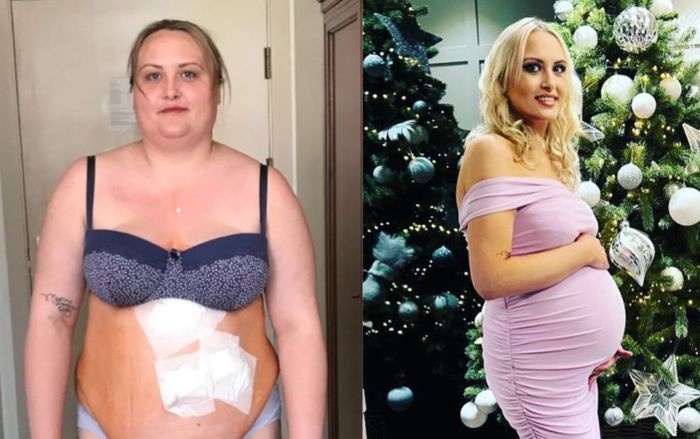 Người phụ nữ giảm 66 kg nhờ phẫu thuật một bộ phận trên cơ thể mà không cần 'hút mỡ'