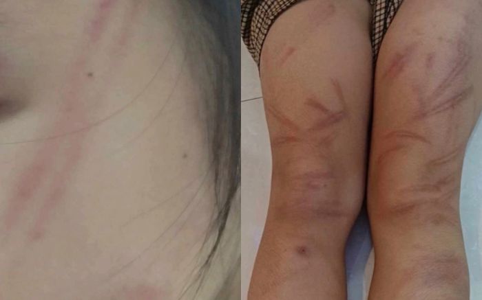 Nhiều trẻ mầm non bị đánh bầm tím cơ thể, công an vào cuộc xác minh