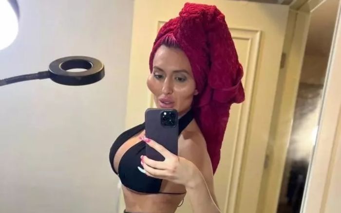 Chi 50 triệu bơm đôi má 'siêu to', nữ người mẫu tuyên bố sẽ chỉnh sửa thêm