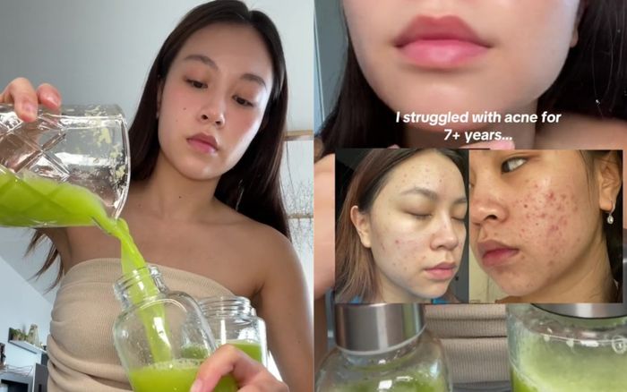 Vật lộn với mụn trứng cá 7 năm, cô gái 'lột xác' cực đỉnh nhờ uống một loại nước