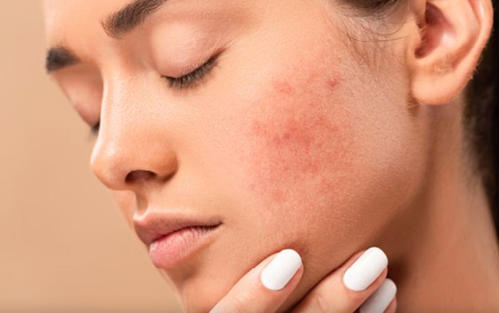 Nên làm gì để giảm thiểu tình trạng kích ứng da do mỹ phẩm?