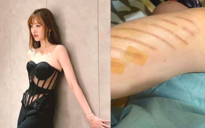 Hari Won gặp chấn thương