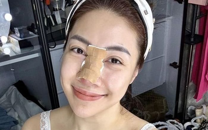 Nữ ca sĩ Việt sửa mũi, sau 12 năm bị viêm nặng, chịu cảnh 'đau tới não' khi tháo sụn