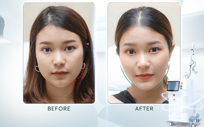 Dịch vụ Thon gọn hàm tại phòng khám Charlie có hiệu quả?