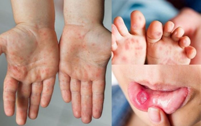 Hà Nội ghi nhận chùm ca bệnh thủy đậu, tay chân miệng trong trường học