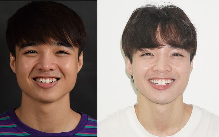 Điểm danh dàn Hot Face thay đổi ngỡ ngàng nhờ niềng răng