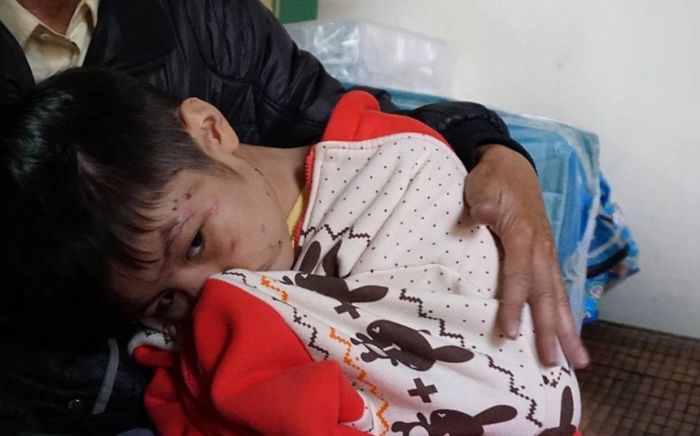 Bé trai bị mẹ ruột và người tình của mẹ dùng dây điện bạo hành