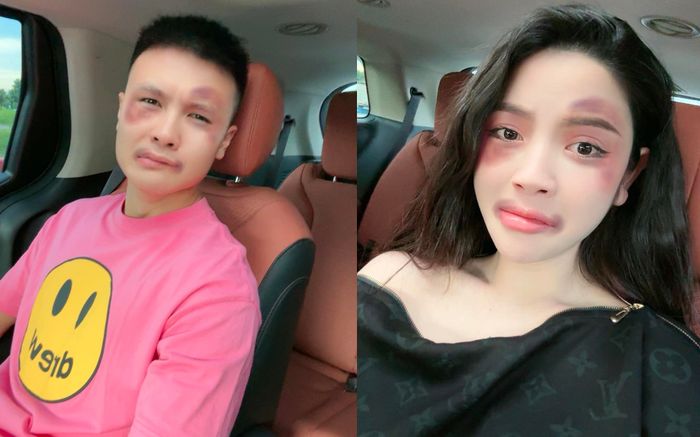 Chuyện gì xảy ra khi vợ chồng Quang Hải bị sưng tím mặt?