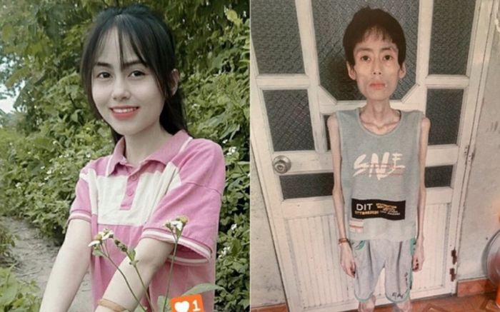 Nhịn ăn cơm để giảm cân, cô gái Hưng Yên xinh xắn có tiếng chỉ còn 18 kg, cơ thể còn da bọc xương