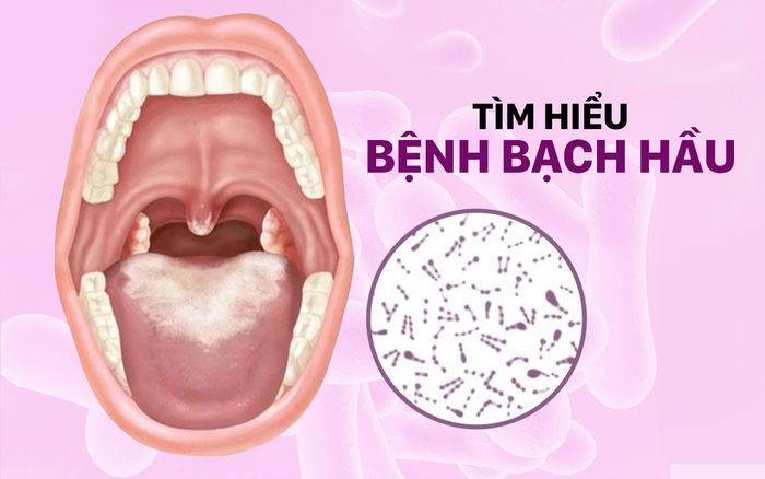 Cô gái 18 tuổi tử vong do bệnh bạch hầu: Tất tần tật về căn bệnh này