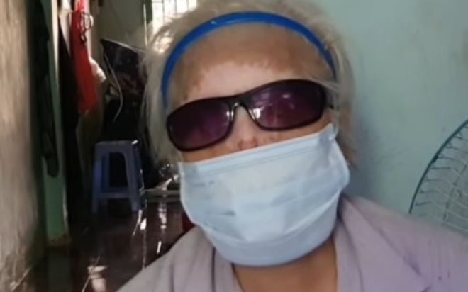 Người phụ nữ bị 'tiểu tam' tạt axit đến biến dạng khuôn mặt