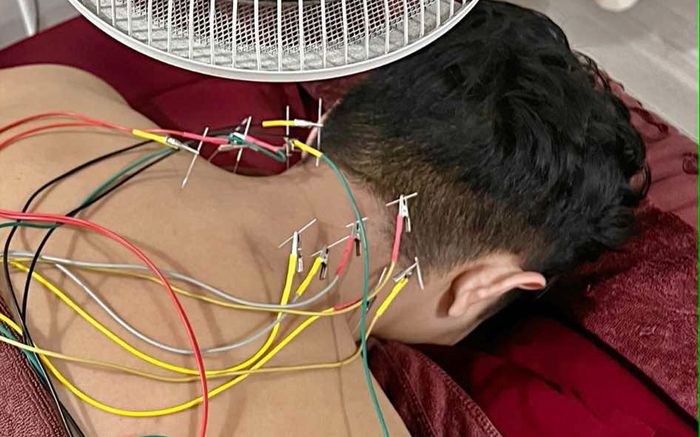 Phan Hiển phải châm cứu đầy lưng, biết lý do ai cũng đồng cảm