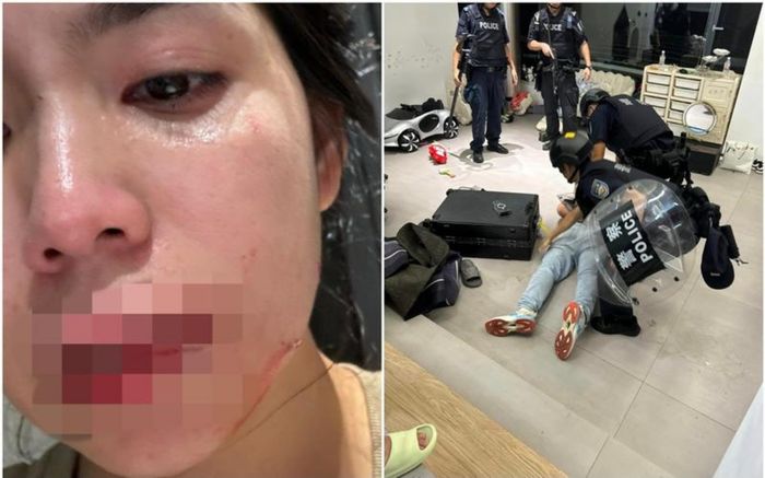 Hằng Du Mục cập nhật tình trạng vết thương, xem ảnh ai cũng xót xa