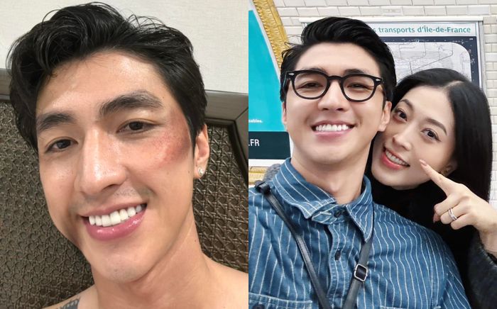 Diễn viên Bình An - chồng á hậu Phương Nga người đầy thương tích, chuyện gì đã xảy ra?