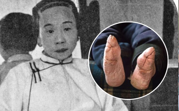 Tập tục bẻ gãy xương để có đôi chân đẹp của phụ nữ Trung Quốc