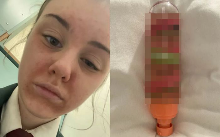 Bé gái 13 tuổi bị bỏng nặng vì sử dụng sữa rửa mặt kém chất lượng