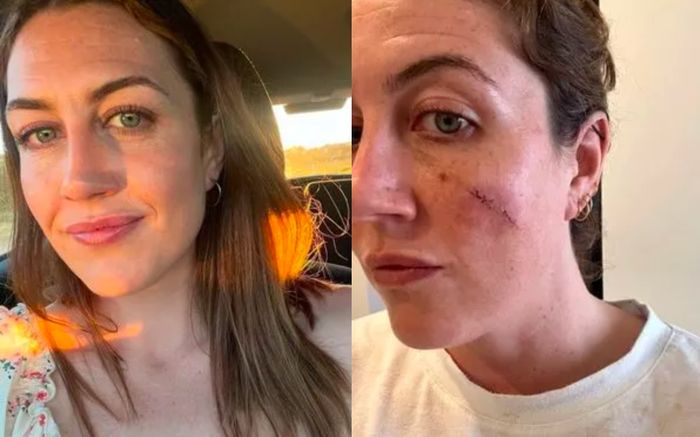 Người phụ nữ bàng hoàng khi nặn vết thâm trên má, phải phẫu thuật và khâu đến 30 mũi