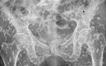 Người đàn ông bị đau hông dữ dội, đi chụp X-quang thì phát hiện điều khó tin