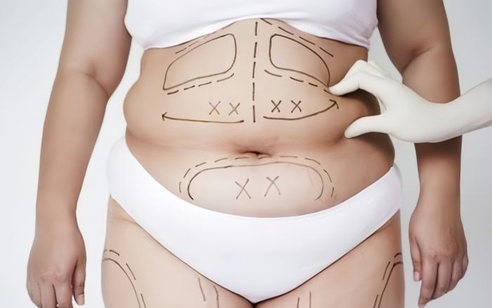 Nỗi ám ảnh vóc dáng hoàn hảo và những bi kịch sau phẫu thuật giảm cân