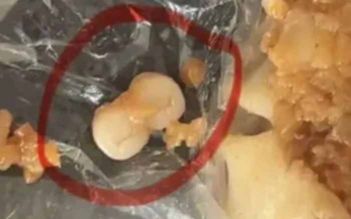 Phát hiện 'răng người' trong xúc xích và bánh bao hấp, mạng xã hội rúng động