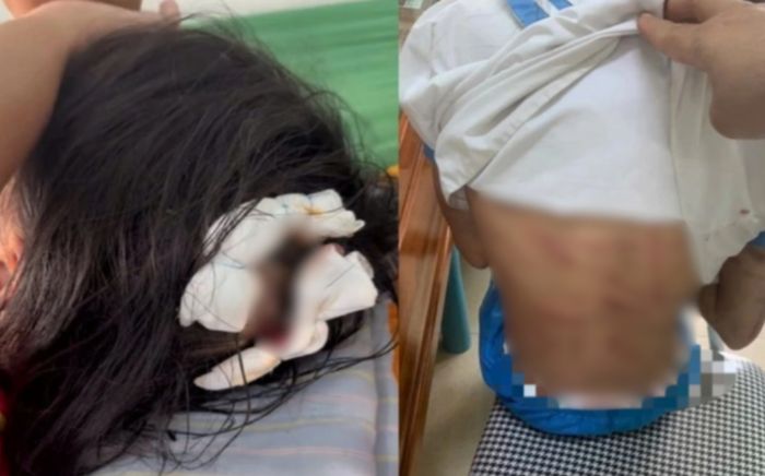 Bé gái ở Hà Tĩnh nghi bị cha dượng bạo hành, cơ thể đầy vết thương