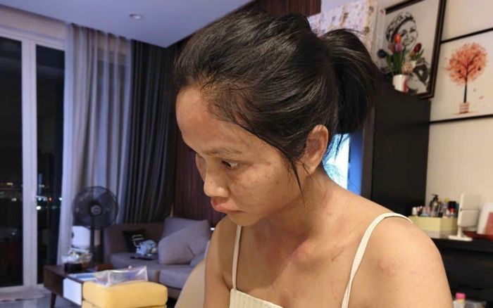 Căn bệnh mà Hoa hậu H'Hen Niê mắc phải sau sinh nguy hiểm ra sao?