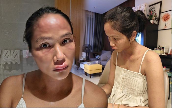 Hoa hậu H'Hen Niê không sợ xấu: Khi mẹ bỉm dám nói thật về bệnh tình sau sinh