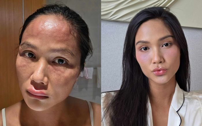 H'Hen Niê lần đầu chia sẻ về việc mắc căn bệnh lạ sau sinh