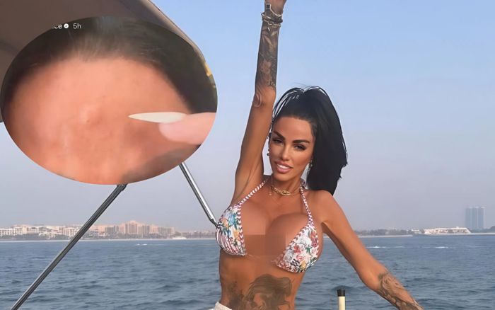 Nữ người mẫu nổi tiếng tiết lộ gương mặt biến dạng nghiêm trọng sau khi thẩm mỹ