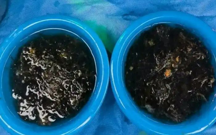 Bé gái 10 tuổi đau bụng suốt 3 năm, bác sĩ sửng sốt khi lấy ra thứ bên trong dạ dày