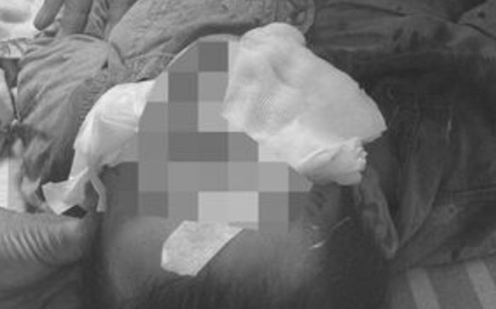 Bé trai 1 tuổi bị con chó cắn vào mặt khi đi ăn tiệc cùng gia đình, phải khâu hơn 100 mũi