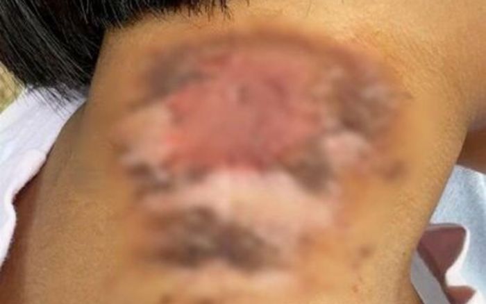 Xôn xao bé gái 4 tuổi bị loét cổ sau khi bị một loài côn trùng cắn, tình trạng khiến nhiều người xót xa