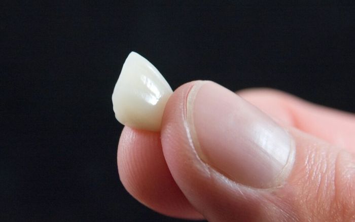 Vì sao răng sứ dễ bị rơi ra trong lúc ăn uống?