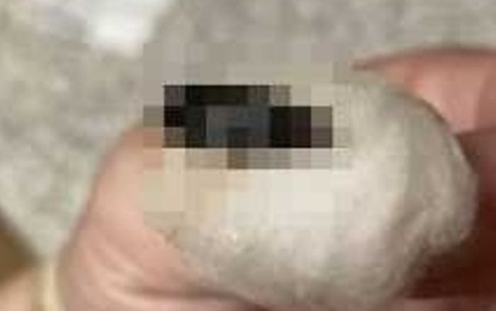 Người đàn ông bị đau một bên tai dữ dội, bác sĩ nội soi thì phát hiện thứ kinh hoàng bên trong