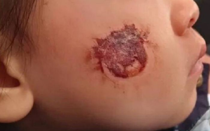 Dán hình lên mặt theo lời cô giáo, bé gái 3 tuổi gặp tình trạng khiến phụ huynh hoảng hốt